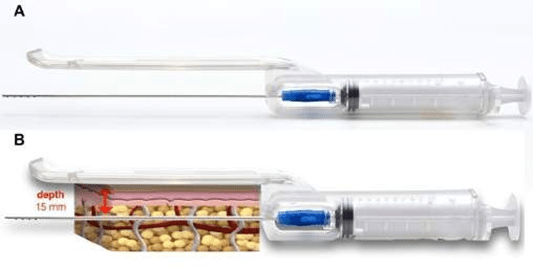 Non-surgical Jowl and Jawline Rejuvenation with Resorbable Suspension ...