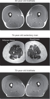 MRI images of thigh region to show effect of exercise on muscle mass.