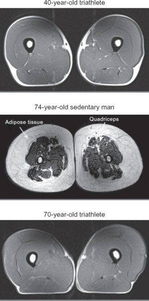 MRI images of thigh region to show effect of exercise on muscle mass.