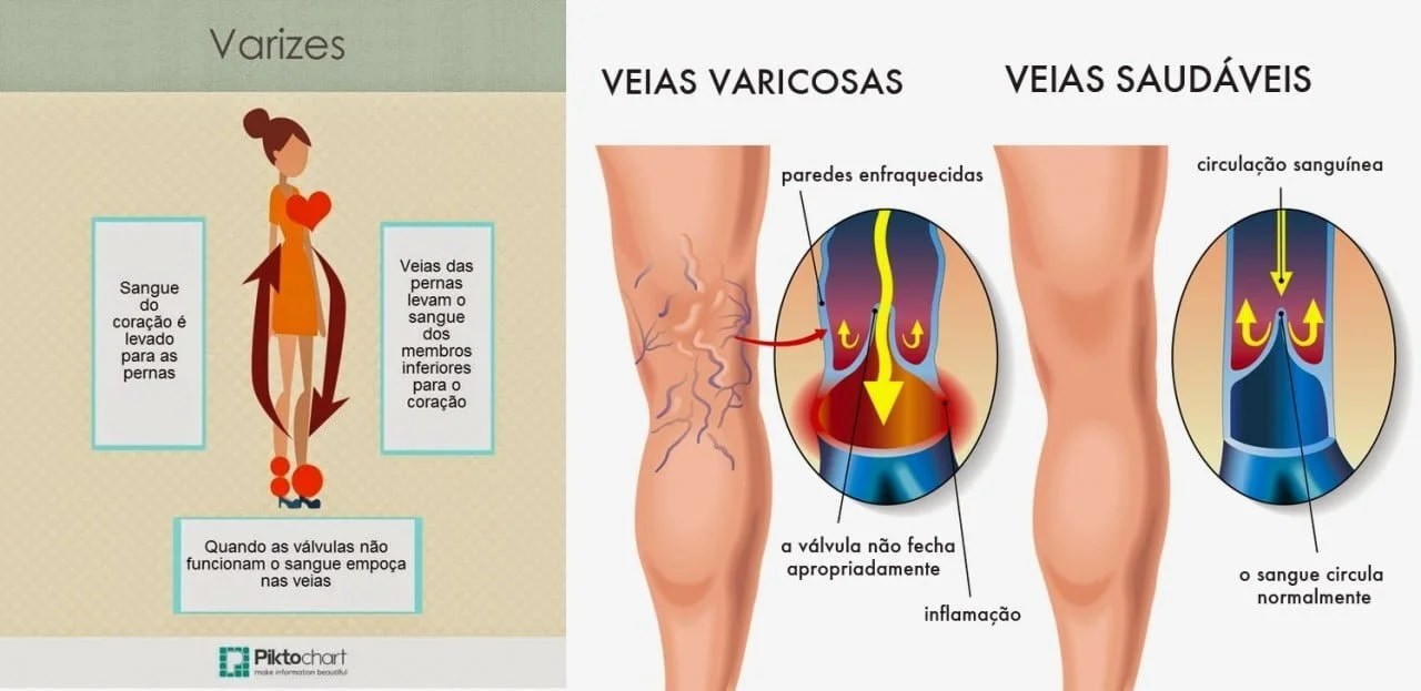Trombose venosa profunda