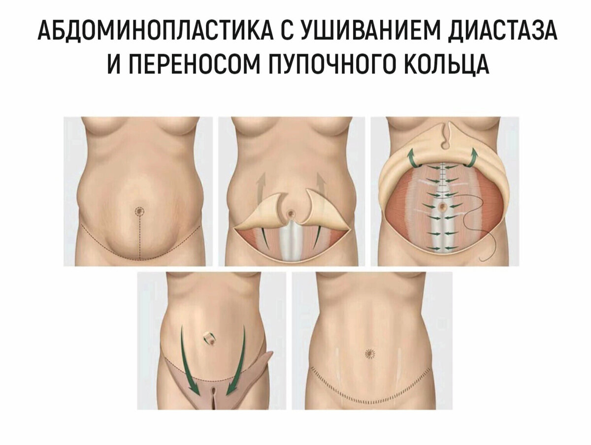 Невероятное "до и после" коррекции живота