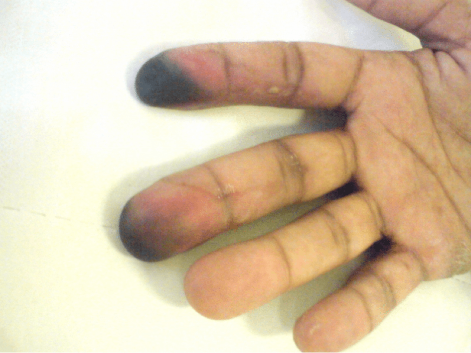 Artérites au cannabis : trois nouveaux cas Figure 3