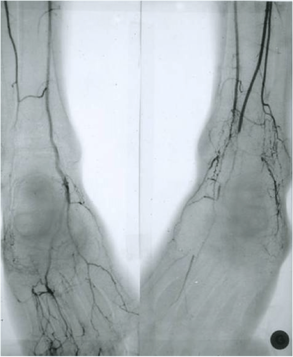 Artérites au cannabis : trois nouveaux cas Figure 4