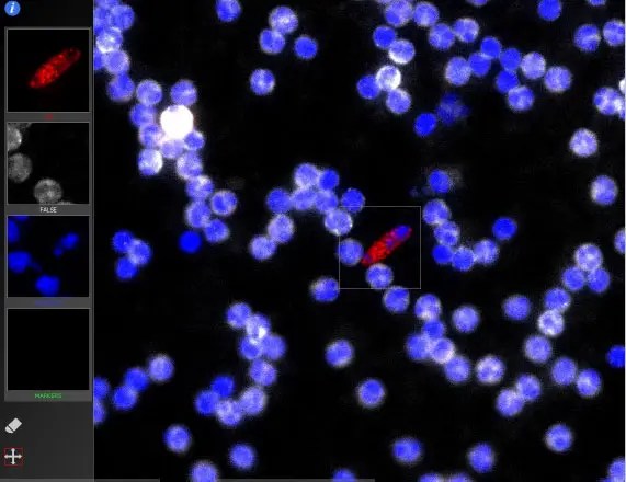 Microscopic image of an apoptotic circulating tumor cell