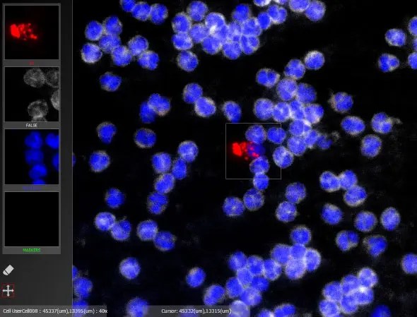 Microscopic image of a second apoptotic circulating tumor cell