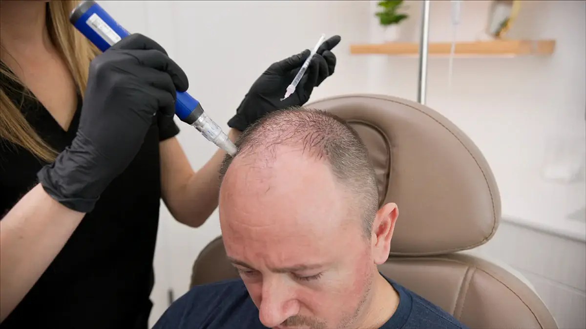 Exosome Hair Restoration vs Stem Cells: Which Is Better?