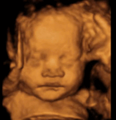 What is the difference between 2d, 3d and 4d ultrasound?