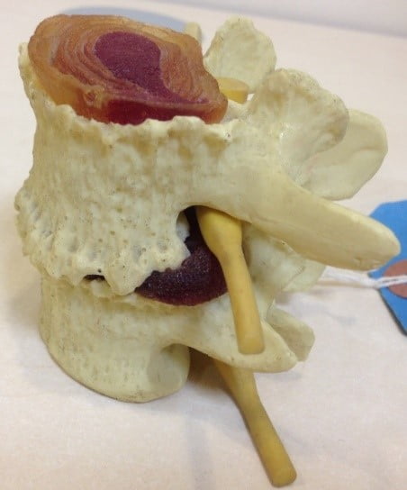 Slipped Disc – Do you have a slipped disc or want to know more about them?