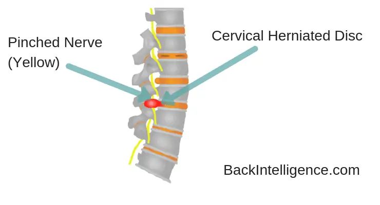 Cervical Herniated Disc Youtube - Download Professional Geometric Pattern | High Resolution