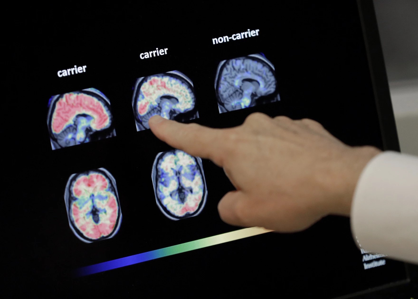In this Aug. 14, 2018 file photo, a doctor looks at PET brain scans in Phoenix. Photo by Matt York/AP.