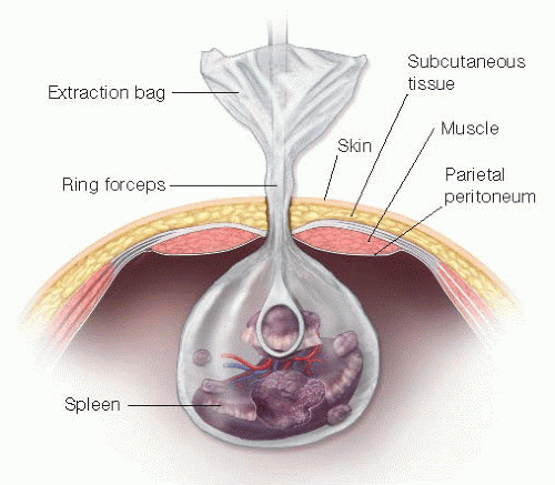 Splenectomy (Open and Laparoscopic Techniques) | Basicmedical Key