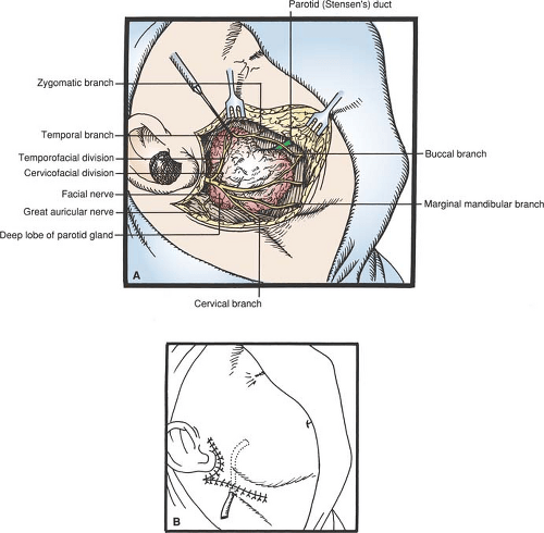 Parotidectomy | Basicmedical Key
