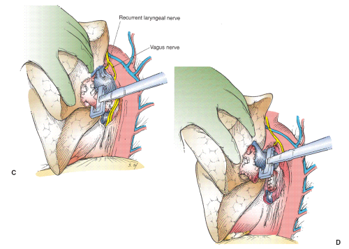Lobectomy | Basicmedical Key