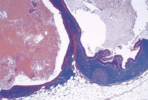 Metastatic Mucinous Adenocarcinoma Basicmedical Key