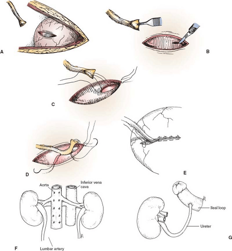 Cadaveric Donor Nephrectomy and Renal Transplantation | Basicmedical Key