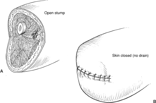 Above-Knee Amputation | Basicmedical Key