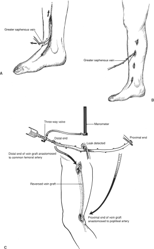 Ligation, Stripping, and Harvesting of the Saphenous Vein