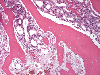 States preventive services task force 'd' recommendation on prostate cancer screening and staging. Contemporary Prostate Cancer Staging | Basicmedical Key