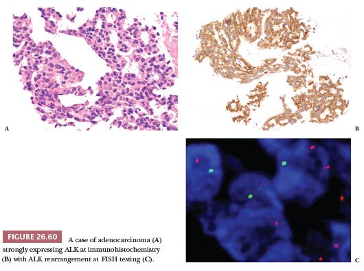 Pulmonary Neoplasms Basicmedical Key