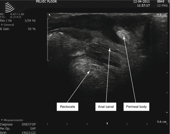 Rectocele Pathophysiology and Presentation Basicmedical Key