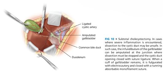 Open Cholecystectomy | Basicmedical Key