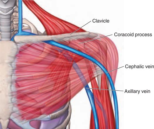 It brings blood from the hand, forearm, and arm back to the heart. Technique For Device Implantation Cephalic Vein Basicmedical Key
