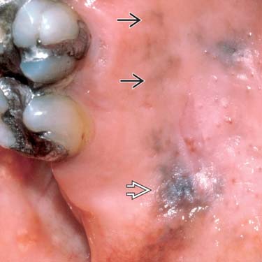 images Malignant Melanoma Mouth oral melanoma basicmedical key