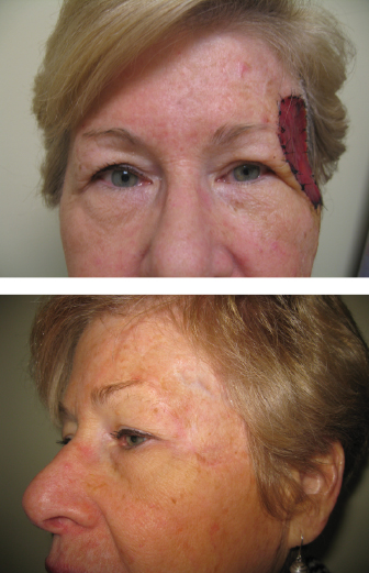 9: Bio-Inspired Design of Skin Replacement Therapies | Basicmedical Key