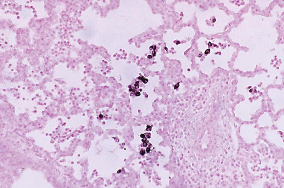 Micrograph of in situ hybridization (ISH) detection of porcine reproductive and respiratory syndrome virus (PRRSV) nucleic acid in the alveolar macrophages of a pig's lung displaying spots of pigments.