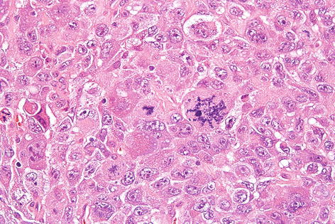 Tumors of Uncertain Differentiation | Basicmedical Key