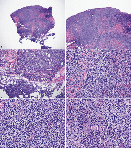 Cutaneous Diffuse Large B Cell Lymphomas Basicmedical Key