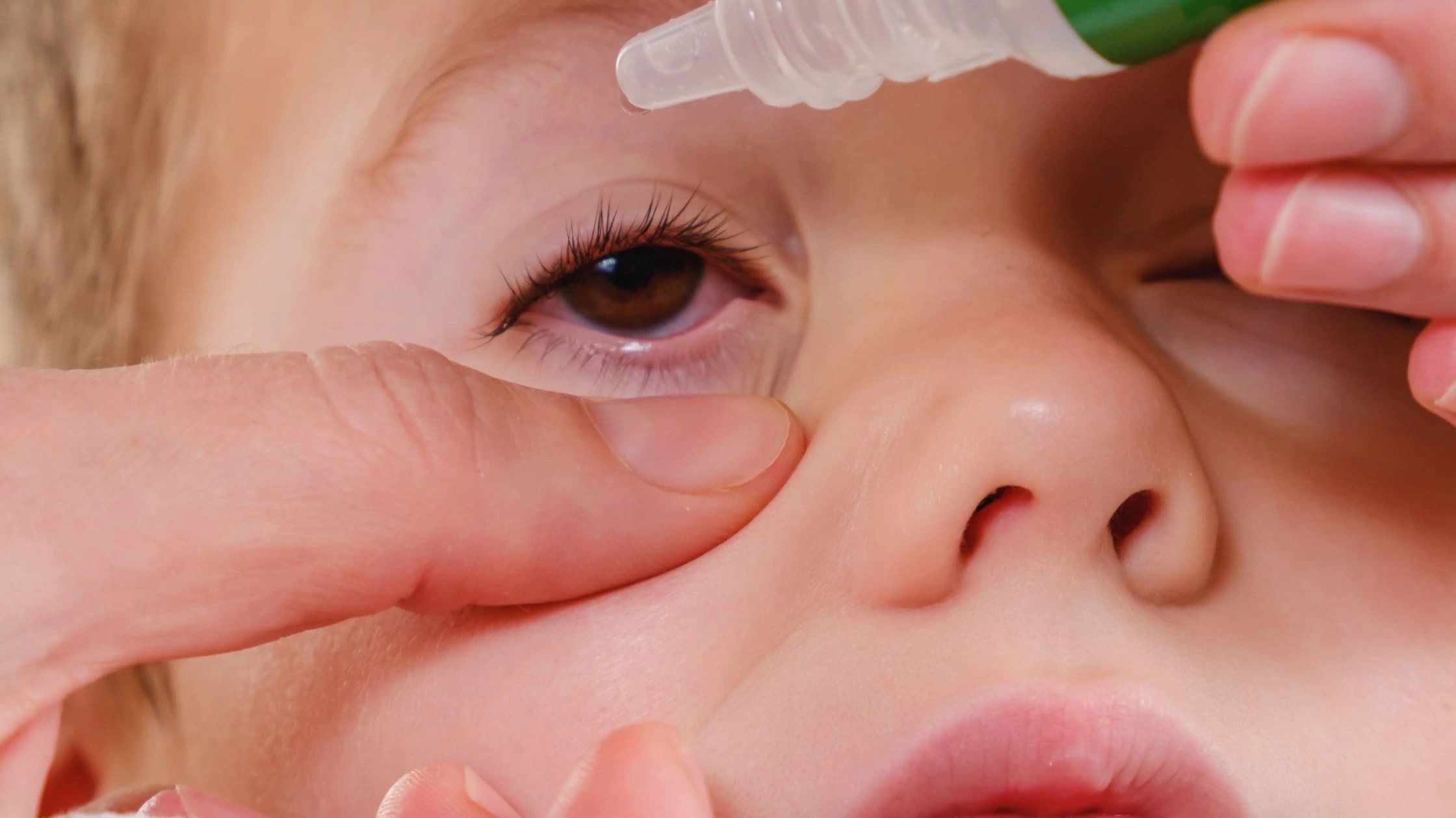 Allergic Conjunctivitis Home Remedies: A Simple Guide for Relief