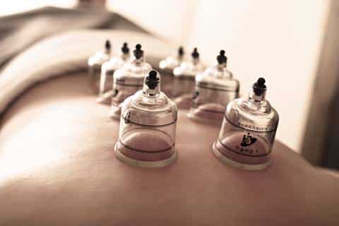 Cupping therapy