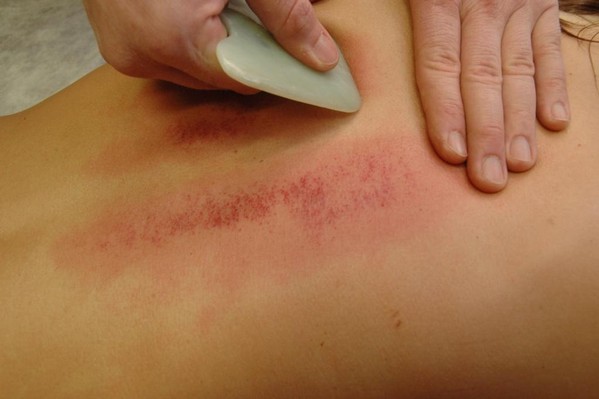 Person getting Gua Sha Massage