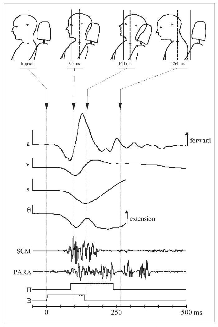 The Biomechanics Of Whiplash Injury British Columbia Medical Journal 