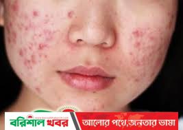 মুখ ভরে যাচ্ছে ব্রণে? কী করবেন