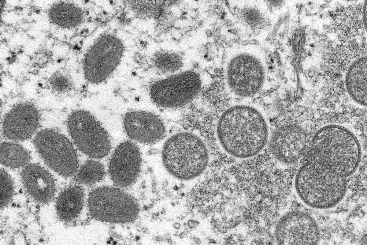 Maine has confirmed its first case of monkeypox.