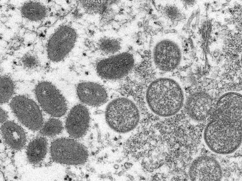 A Texan infected with monkeypox has died.