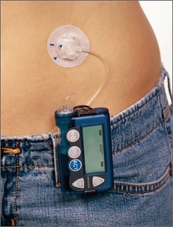 insulin pump