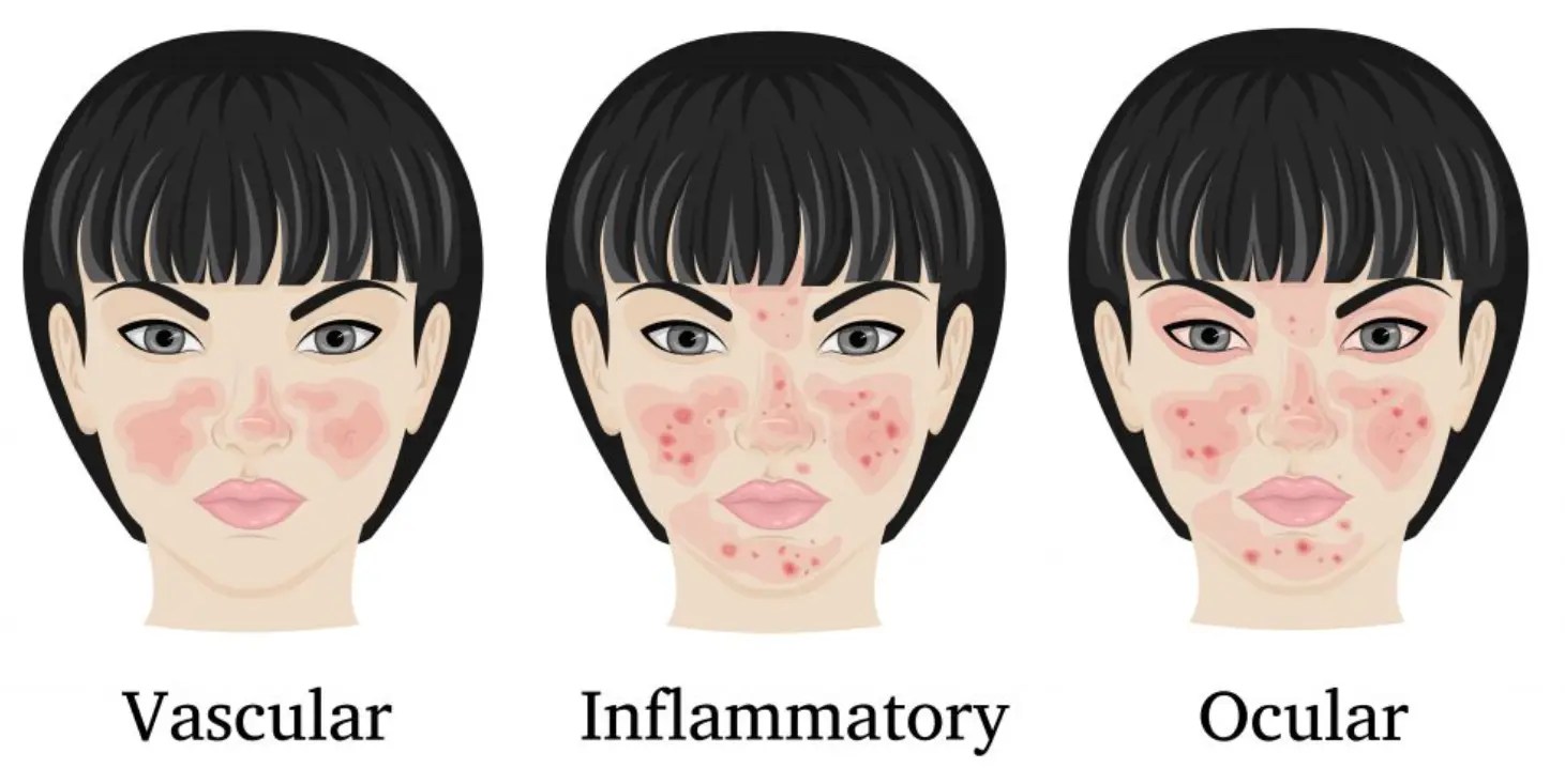 Types of Rosacea