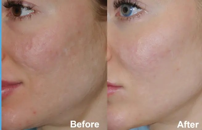 Acne Treament