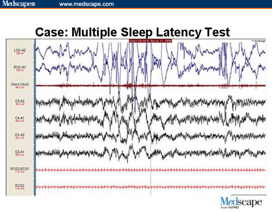Multiple sleep latency test. Multiple sleep latency test. Mslt-тест. Тест с множественной задержкой сна. Sleep latent test animation.