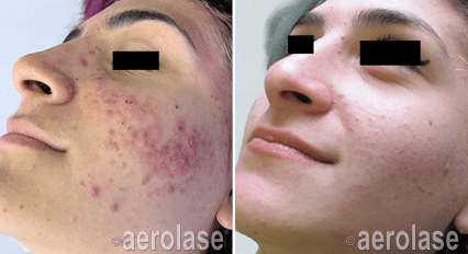 Laser Acne Treatment Before and After