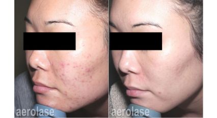 Laser Acne Treatment Before and After