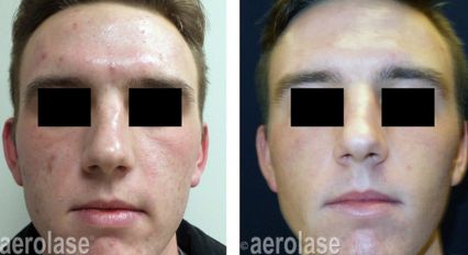 Laser Skin Rejuvenation Before and After