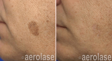 Laser Pigmented Spots Treatment Before and After