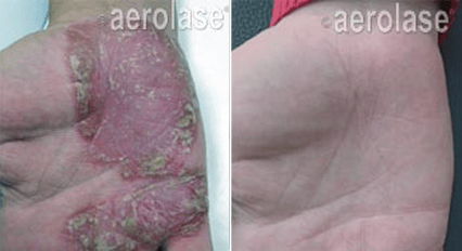 Laser Psoriasis Treatment Before and After