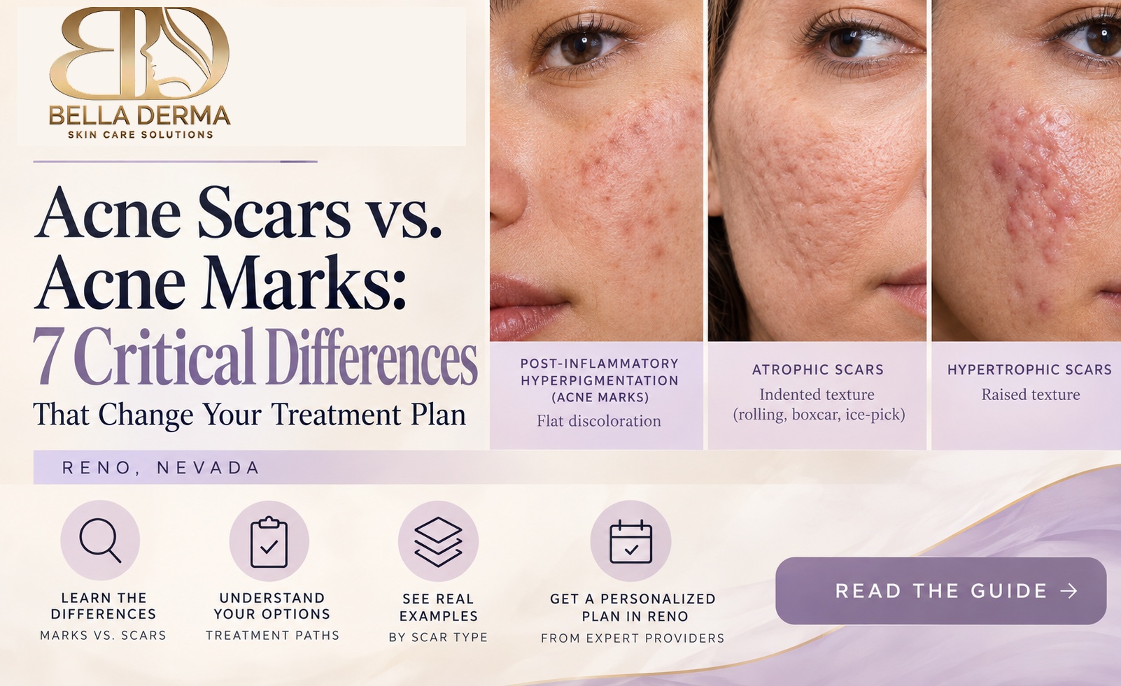 Bella Derma acne scars vs acne marks in Reno showing key differences between discoloration and structural scarring
