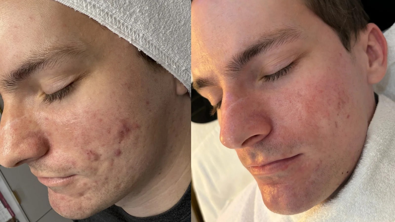 Before and after skin texture and acne appearance following PDRN microneedling.