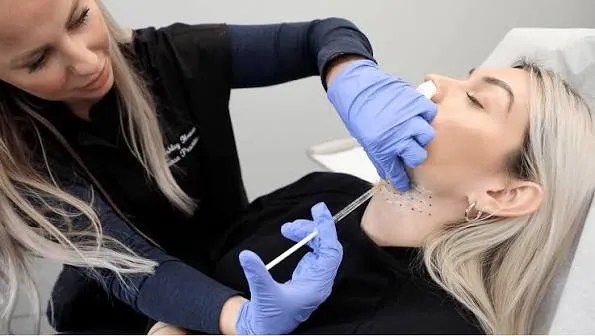 Kybella in Reno educational image showing the submental treatment area